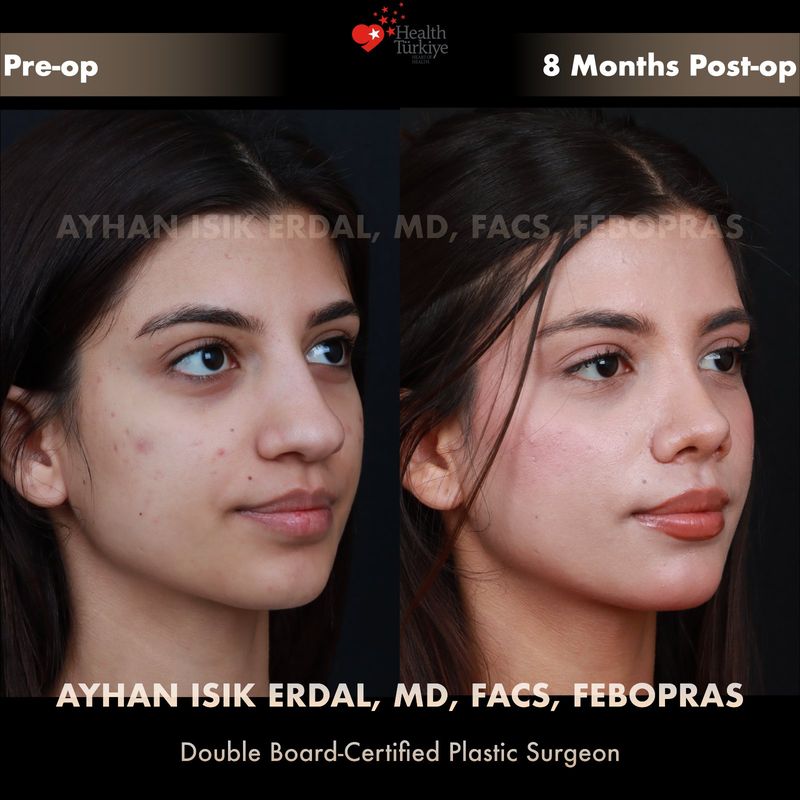 Vaka AC - profil görünüm öncesi sonrası
