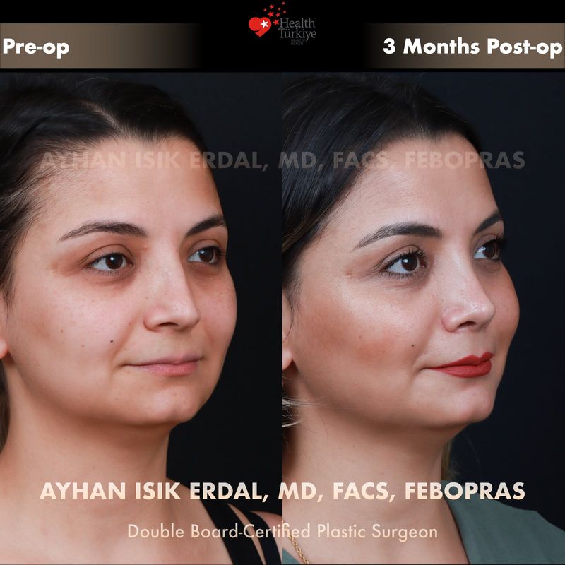 Vaka DA - profil görünüm öncesi sonrası