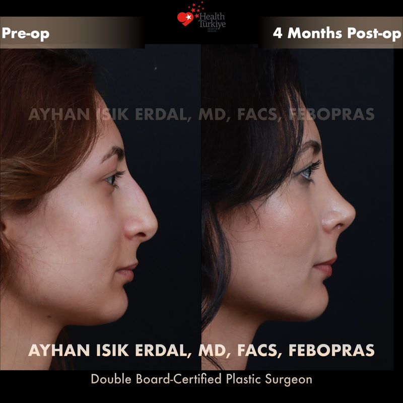 Vaka DS - profil görünüm öncesi sonrası