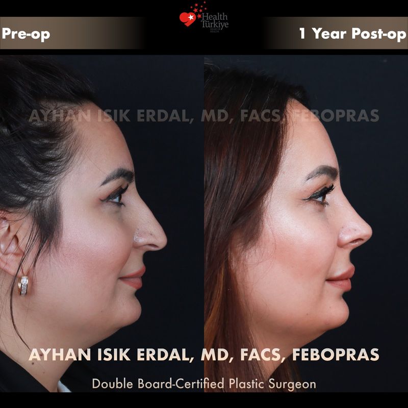Vaka ED - profil görünüm öncesi sonrası