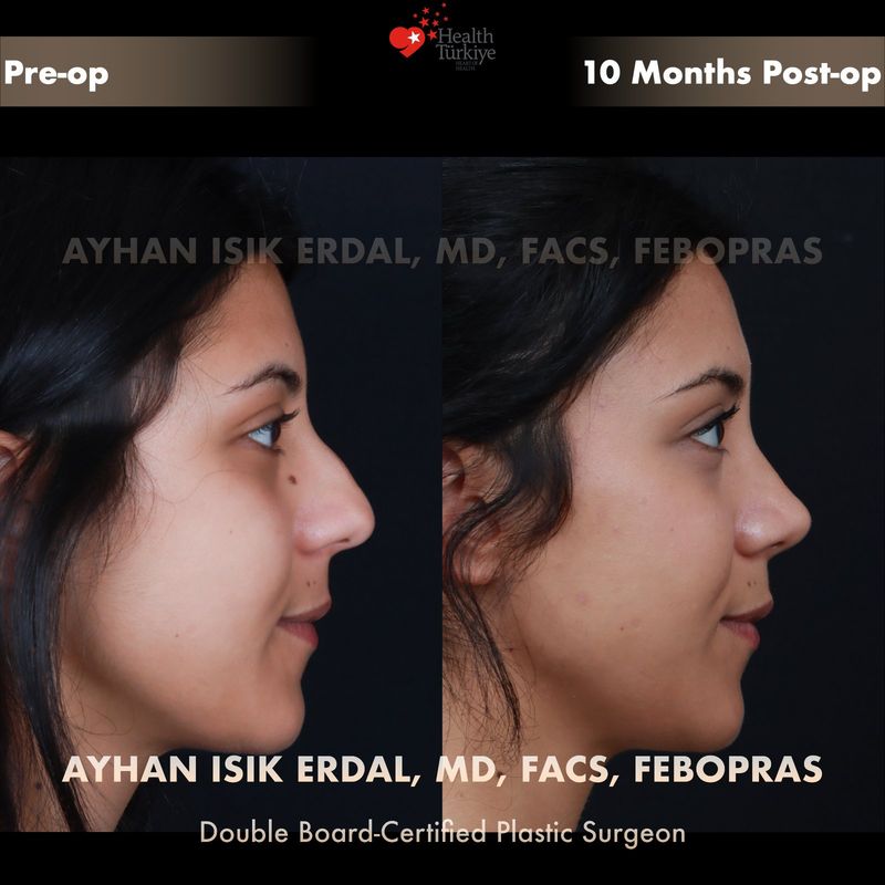 Vaka EU - profil görünüm öncesi sonrası
