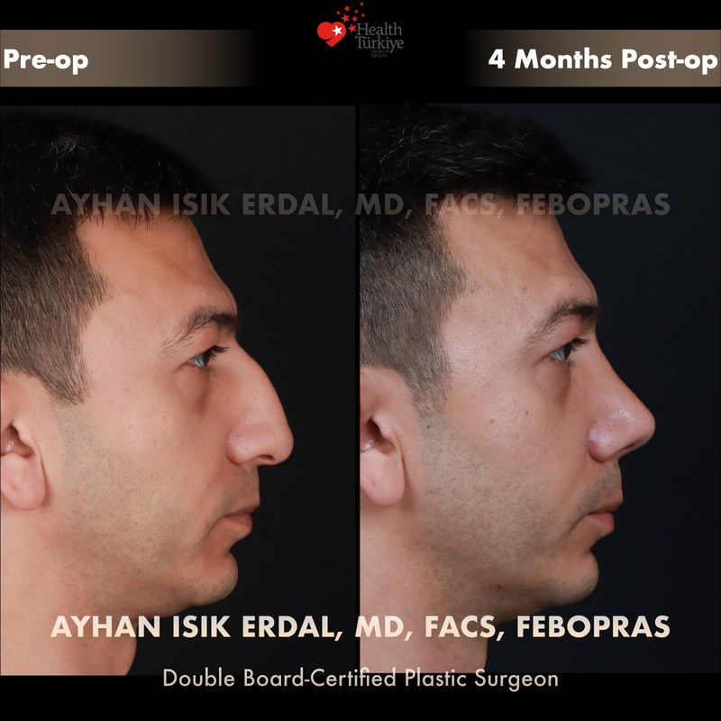 Vaka KD - profil görünüm öncesi sonrası