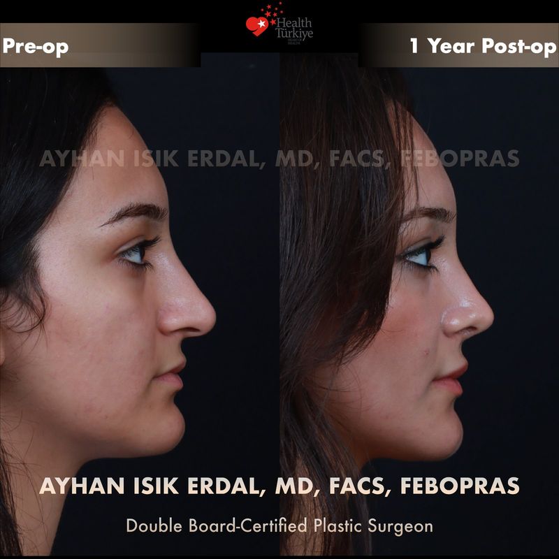 Vaka NK - profil görünüm öncesi sonrası