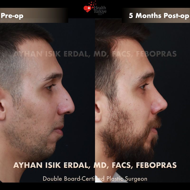 Vaka TO - oblik (3/4) görünüm öncesi sonrası