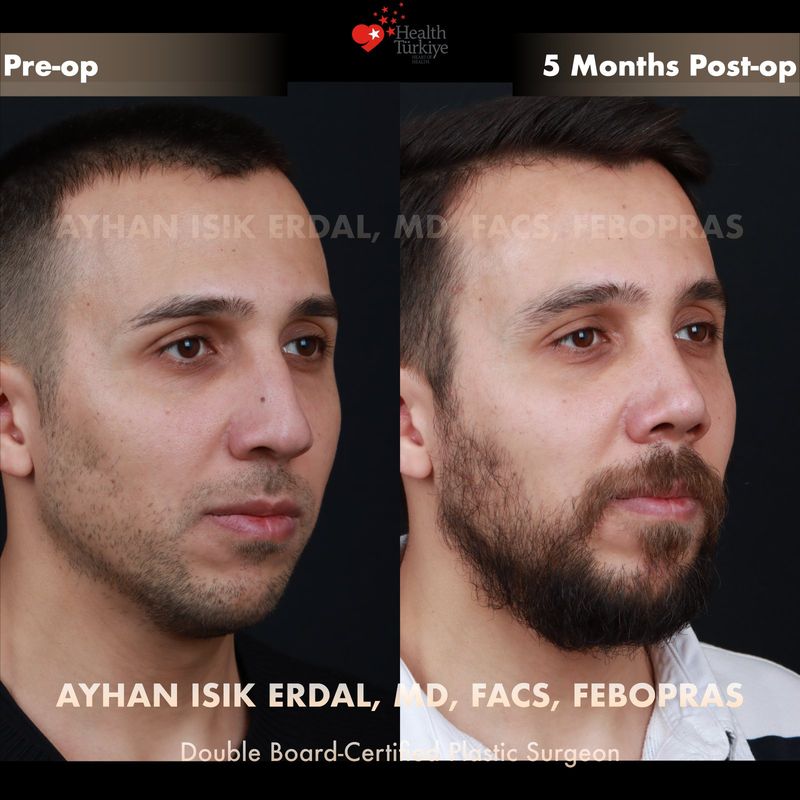 Vaka TO - profil görünüm öncesi sonrası